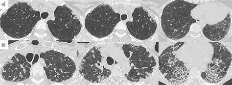 Pleuroparenchymal fibroelastosis in systemic .